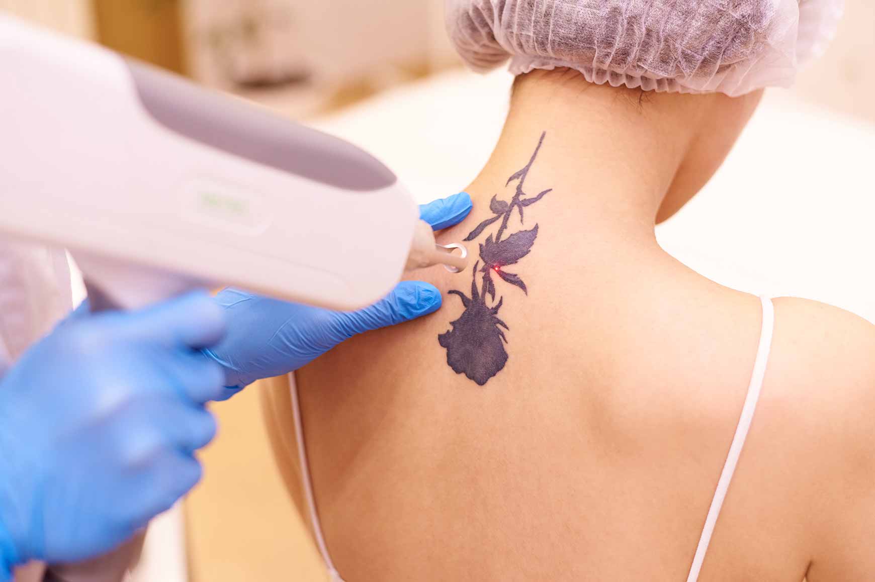 Laser Tattoo Removal Dubai